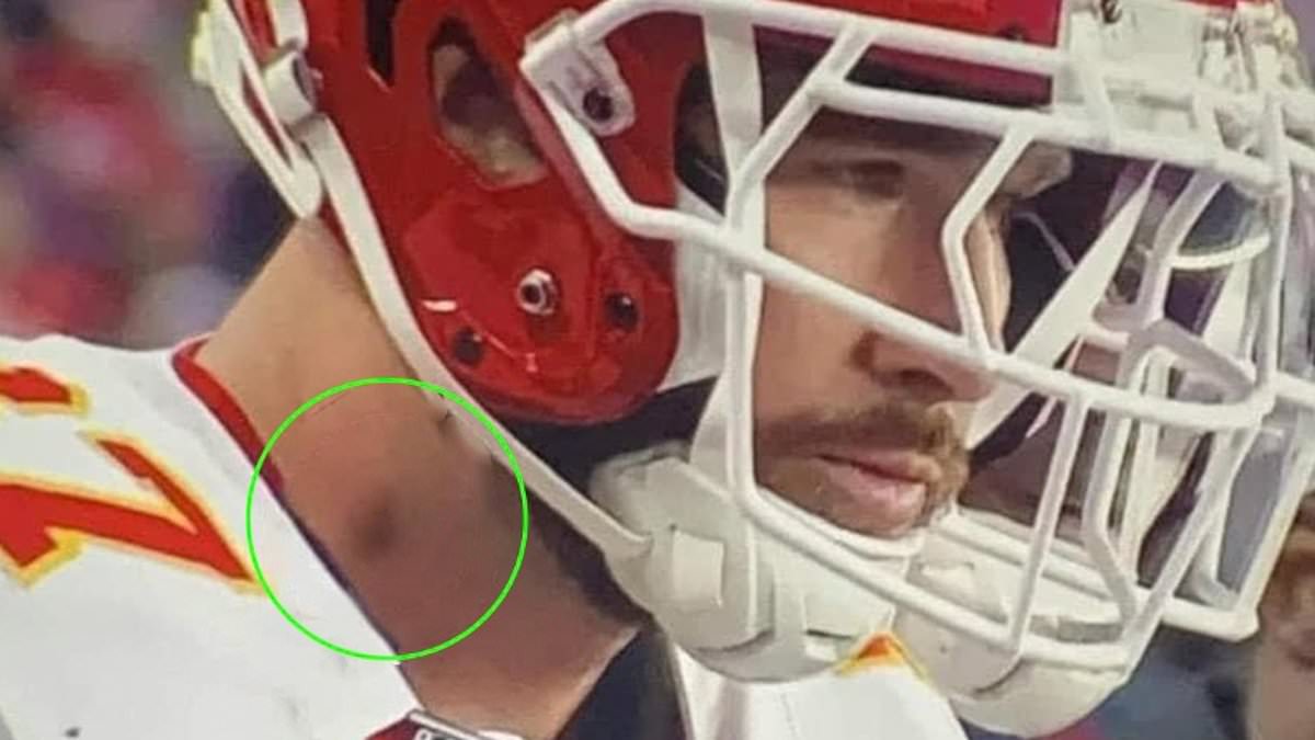 taylor-alert-–-taylor-swift-and-travis-kelce-fans-go-wild-after-spotting-‘hickey’-on-nfl-star’s-neck…-but-pat-mcafee-defends-pair-and-says-they’re-‘just-having-fun’